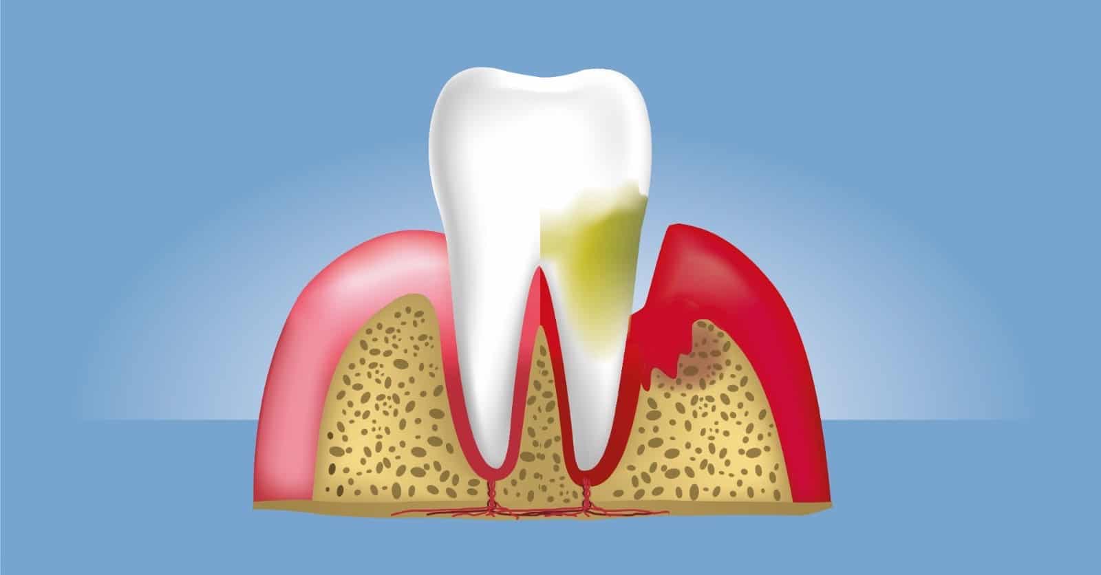 Nega desni u Ersa Dentalu