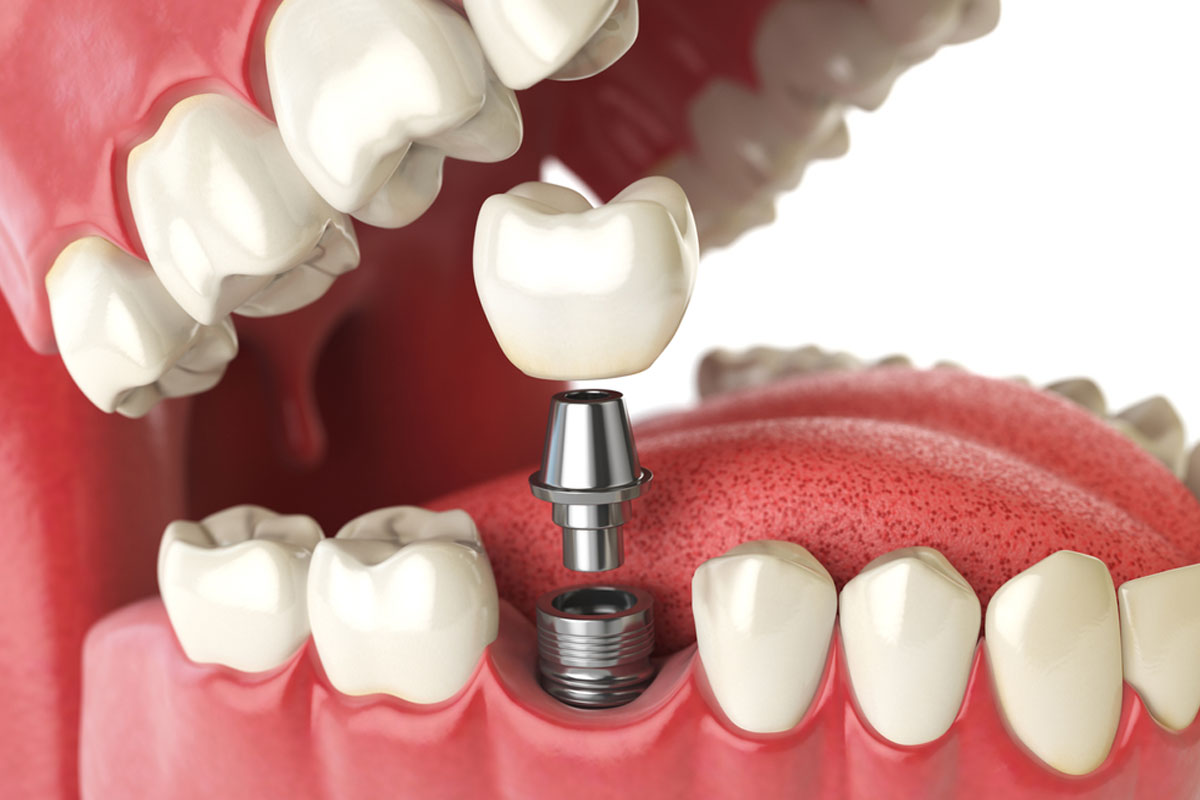Zubni implantati u Ersa Dentalu