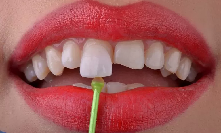 Porcelanske fasete u Ersa Dentalu