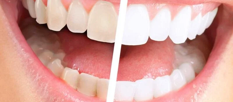 Izbeljivanje zuba u Ersa Dentalu