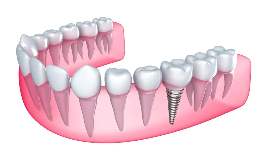 beylikdüzü dental implant