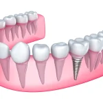 beylikdüzü dental implant
