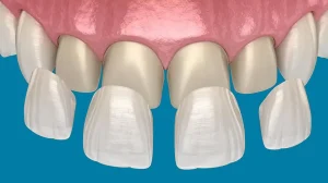 beylikdüzü porselen lamine diş tedavisi